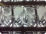 lymphoma spleenl