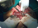 pancreatic necrosectomyq