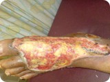 cellulitise