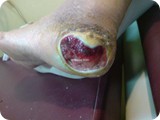 diab foot ulcerh